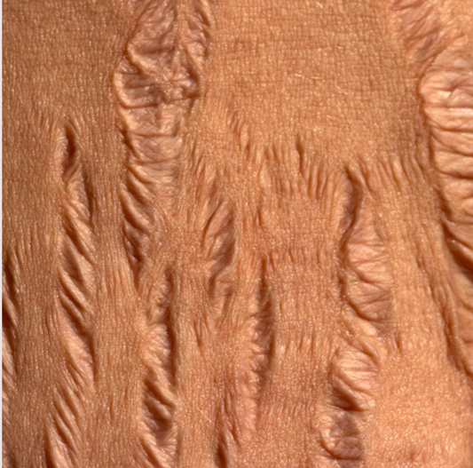 Choosing Natural: An Effective Solution for Stretch Marks