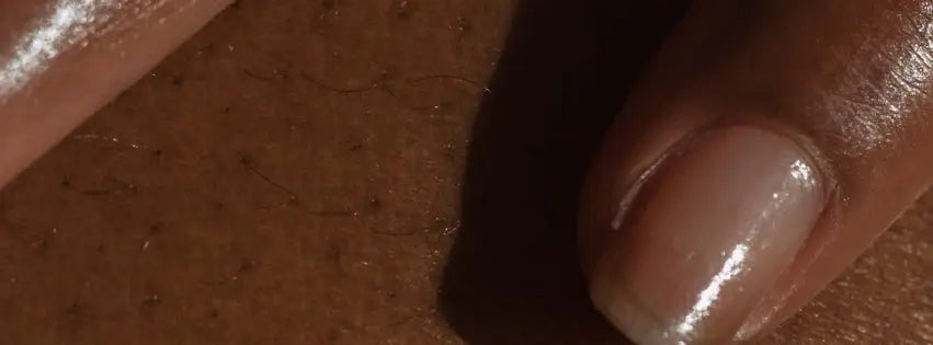 Melananated Skin Needs Sunscreen! Nzema Appolo