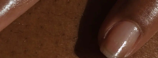 Melananated Skin Needs Sunscreen! Nzema Appolo