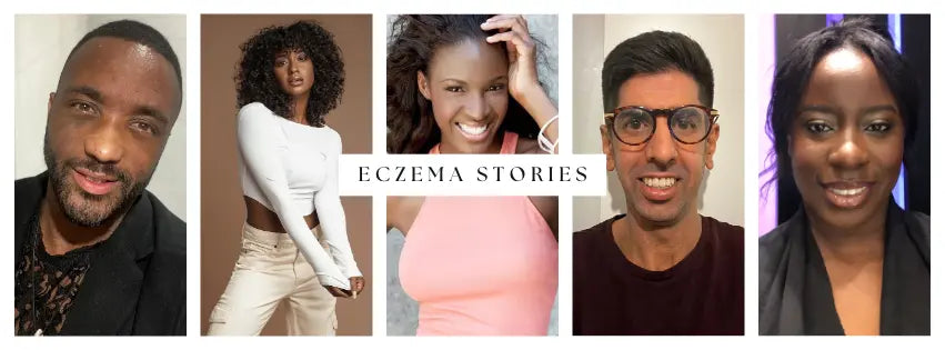 Real Life Eczema Stories Nzema Appolo