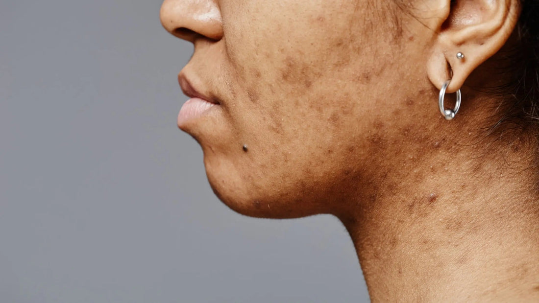Hyperpigmentation 101: Why Melanin Skin Recovers Differently and How to Heal It Nzema Appolo