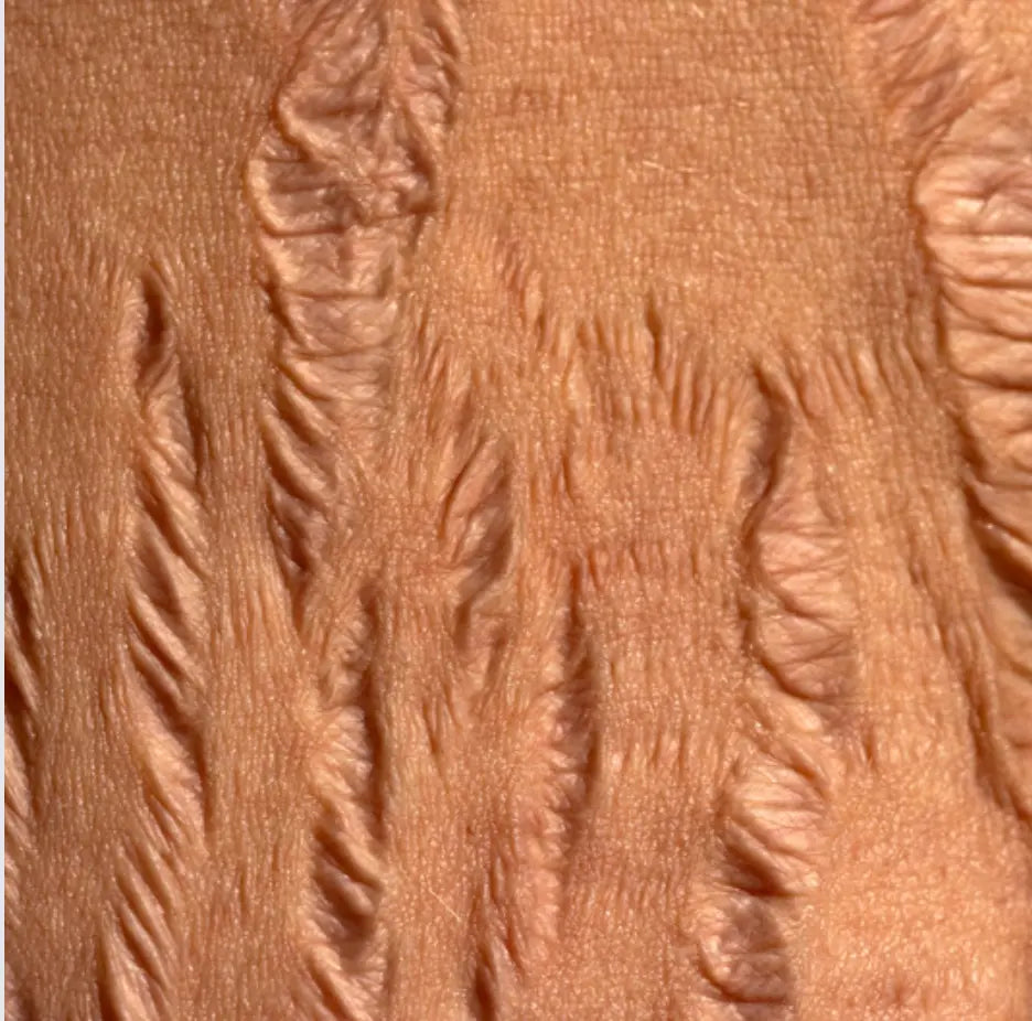 Choosing Natural: An Effective Solution for Stretch Marks Nzema Appolo