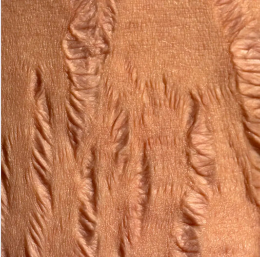 Choosing Natural: An Effective Solution for Stretch Marks Nzema Appolo